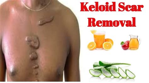 Best Treatment For Keloids How To Remove Keloid Ointment For Keloids Youtube