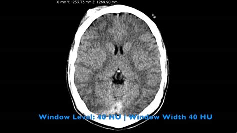 A ct scan (or cat scan) is best suited for viewing bone injuries, diagnosing lung and chest problems, and detecting cancers. CT Scan of the Head: A Radiologist's Approach - YouTube