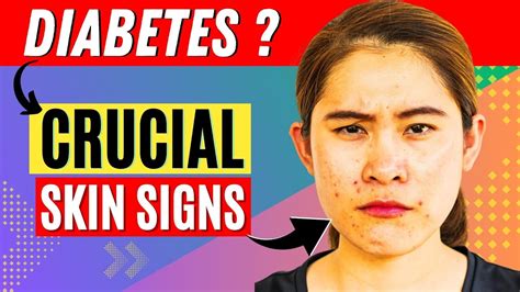 10 Crucial Skin Signs Of Diabetes You Shouldnt Ignore Youtube