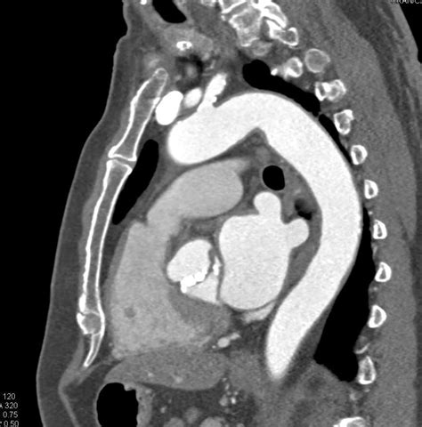 Bicuspid Calcified Aortic Valve With Aortic Stenosis Cardiac Case