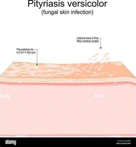 Pityriasis Versicolor Fungal Skin Infection Cross Section Of A Human The Best Porn Website