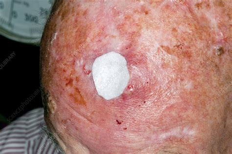 Wound After Skin Cancer Removal Stock Image C0130986 Science