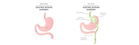 Having medical insurance doesn't mean you won't need to pay for all or part of the procedure yourself. Gastric bypass before after surgery | Obesity Coverage