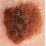 Pictures Of Skin Cancer Melanoma