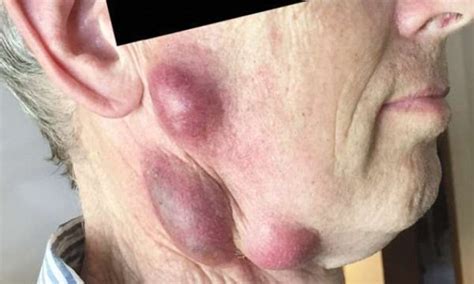 Man Had Boils On His Neck After Catching An Infection From