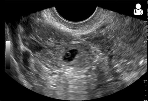 In most countries, the first scan of a pregnant woman takes place between weeks 8 and 14. 5 Conditions Ultrasound Imaging Can Detect | Probo Medical