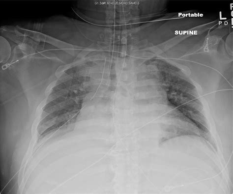 Initial Chest X Ray Cardiac And Mediastinal Silhouette Enlarged