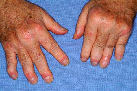 Psoriatic Arthritis Causes Symptoms Homeopathic Treatment