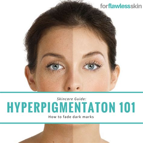 Hyperpigmentation What It Is And How To Treat It For Flawless Skin