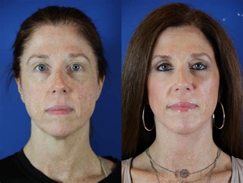 Co2 Laser Skin Resurfacing Before And After Photos Patient 49 Brentwood