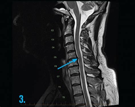 Mri Cervical Spine Radiculopathy Gp Series Mri At Melbourne Radiology