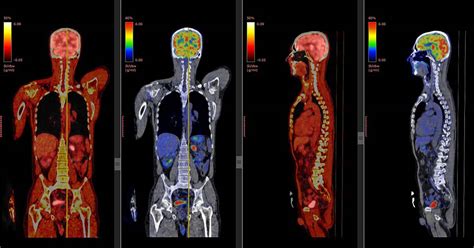 What Is A Pet Scan And What Is It Used For Health365
