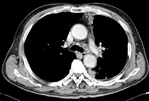 Chest Ct Scan Shows Multiple Enlarged Lymph Nodes In The Left Hilum And
