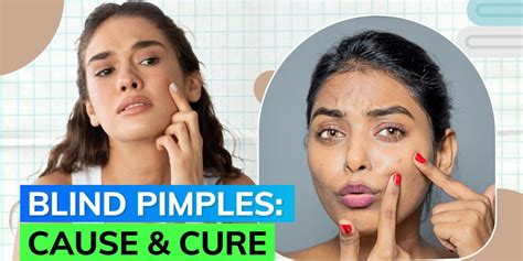 know what ‘blind pimples are and what causes them on your skin editorji