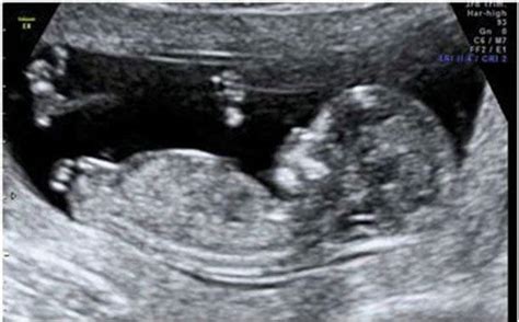 bushra s ultrasound blog a helpful tip for 12 weeks scan