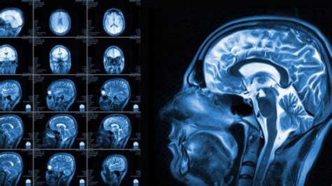 Neuroimaging Study Reveals Brain Difference In People With Adhd