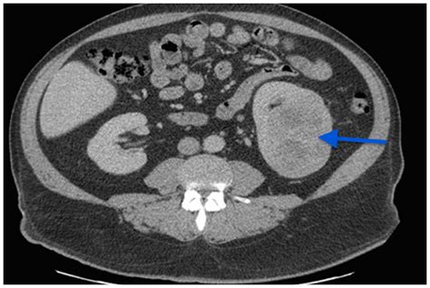 Recurrent Metastatic Clear Cell Renal Carcinoma With Sarcomatoid