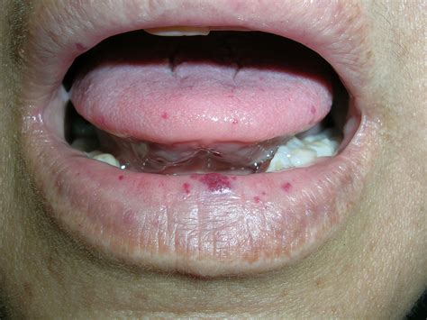 Spots On Tongue Mdedge Family Medicine