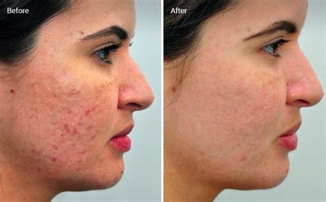 How Much Is Laser Acne Scar Removal Medcoo