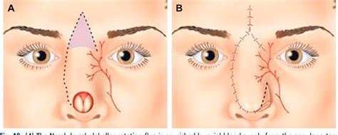 Figure 3 From Transposition Flaps In Nasal Reconstruction Semantic