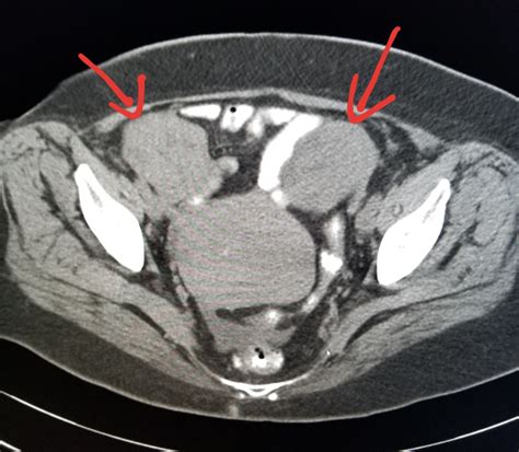 What Does Ovarian Cancer Look Like On A Ct Scan What Does