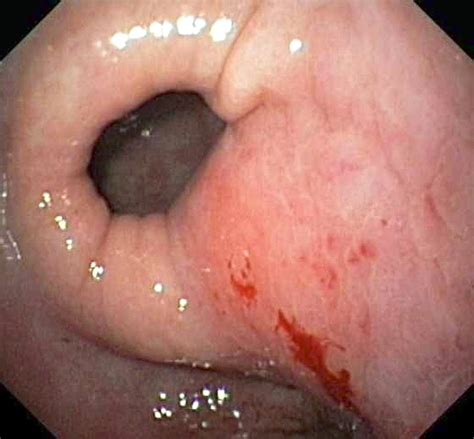 It might be there all the time or get worse after eating. Stomach Cancer Photograph by Gastrolab