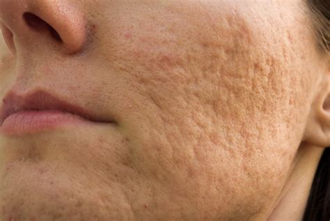 Laser treatment of acne scars. Laser Treatment for Acne Scars & Pores | PicoSure for Acne ...