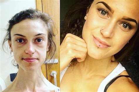 Former Anorexic Girl Credits Instagram Recovery Accounts For Saving Her