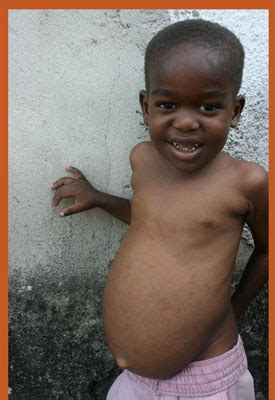 Kwashiorkor is a form of malnutrition that occurs when there is not enough protein in the diet. eLimu | Food and Nutrition