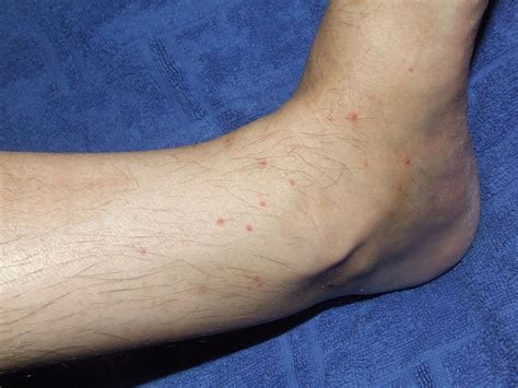 Flea Bites On Humans Symptoms Treatment And More Dengarden
