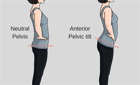 Anterior Pelvic Tilt Downward Posture Hip And Back Pain