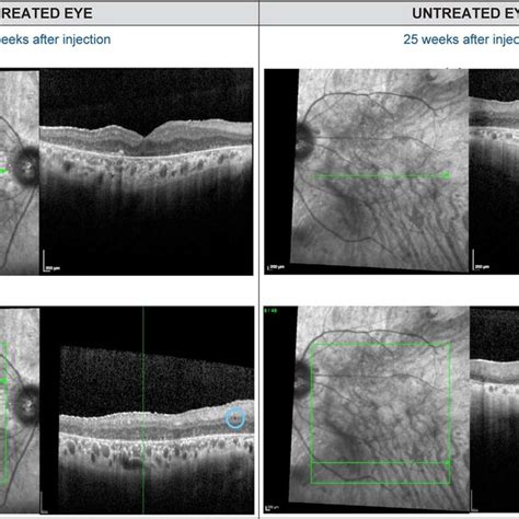 Oct Imaging Of The Retina 4 Weeks Before Injection Oct Scans Of The