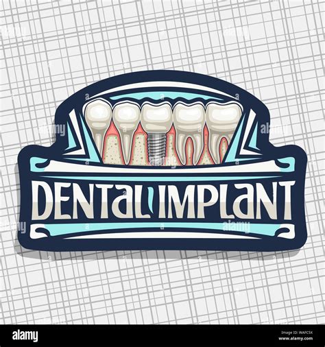 Vector Logo For Dental Implant Dark Decorative Label With 5 Cartoon Human Teeth In Jaw