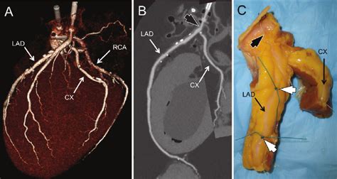A Volume Rendered Ct Reconstruction Of Coronary Anatomy Cx