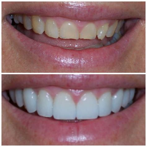Full Smile Makeover success! | Smile makeover, Smile ...