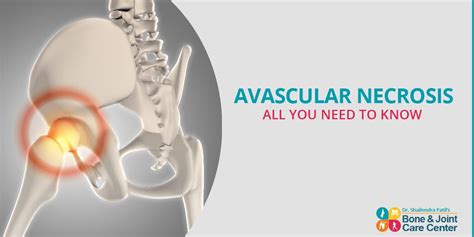 What Is Avascular Necrosis Causes Stages And Treatment Dr