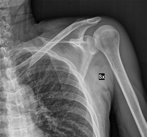 Posterior Shoulder Fracture Dislocation Image Radiopaedia Org My Xxx Hot Girl