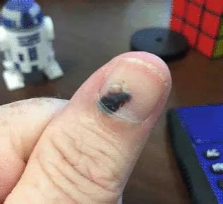 And it also depends on what source you are citing. Blood Blister In Broken Nail Grows Out And Heals Over 5 ...
