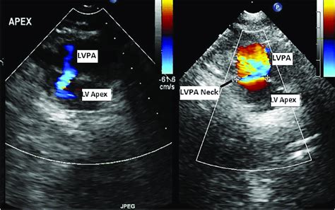 Two Dimensional Transthoracic Echocardiography Showing Cross Sectional