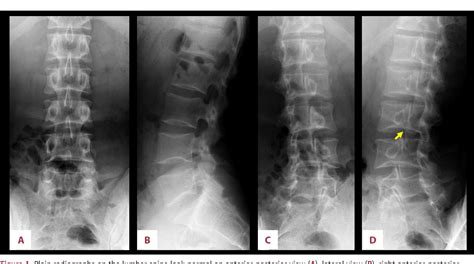 Figure 1 From Osteoid Osteoma Can Occur At The Pars Interarticularis Of