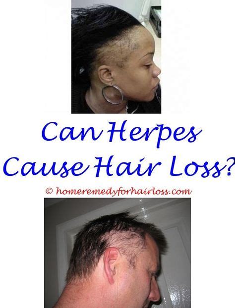 Fibromyalgia And Hair Loss Resolve Abouthairloss