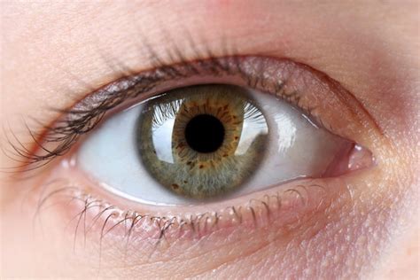 Eye Freckles Dark Spots On Iris Linked To Sun Exposure Risk Of