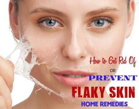 How To Get Rid Of Or Prevent Flaky Skin Home Remedies Paperblog
