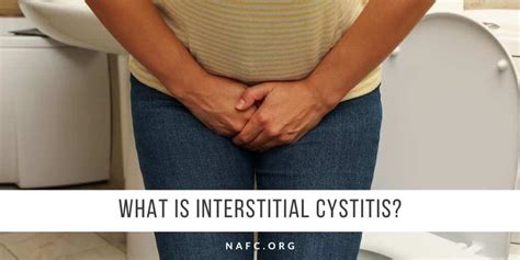 What Is Interstitial Cystitis Nafc