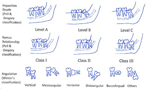 The Impaction Depth Ramus Relationship And Angulation Classification