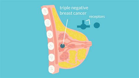 What Is Triple Negative Breast Cancer