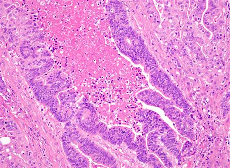 Endometrioid Carcinoma With Necrosis Light Micrograph Stock Image