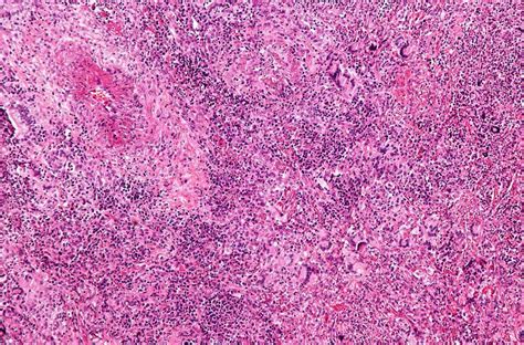 Granulomatosis With Polyangiitis A Patient Benefits From