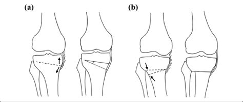 Illustrations Of Opening Wedge A And Closed Wedge B High Tibial