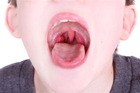 Signs Of Strep Throat Scott N Bateman MD Ear Nose And Throat